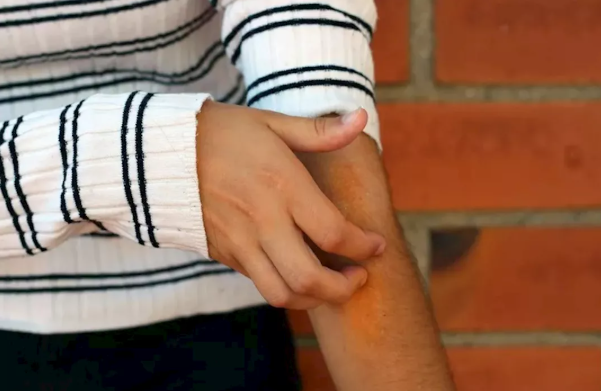 الشعور بزحف الحشرات على الجلد ..  عرض غامض هل يرتبط باضطرابات نفسية؟