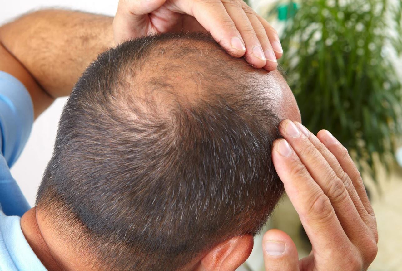 لهذا السبب يتساقط الشعر عند الرجال