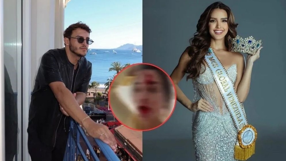 بكدمات على وجهها ..  ملكة جمال فنزويلا تتهم مصفف شعر بضربها في كان