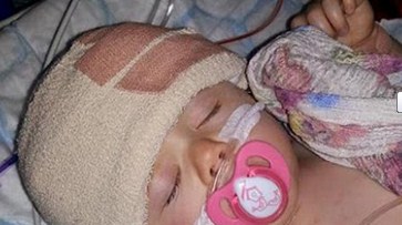 إعادة بناء جمجمة طفلة ولدت برأس ملتوية