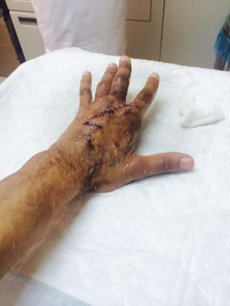 بالصور ..  إنقاذ يد "المالكي" من البتر بعد 10 عمليات جراحية بالطائف
