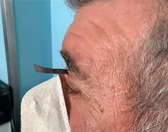 ينغرس مسمار في حاجبه بسبب خطأ