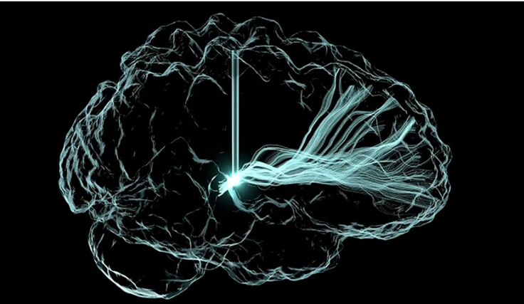 تطوير غرسات دماغية تعالج الاكتئاب والألم المزمن
