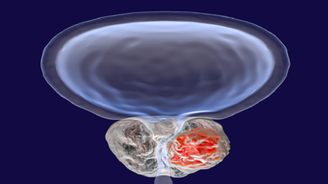 تحذير للرجال ..  أطعمة شائعة الاستهلاك قد تضر بصحة البروستات