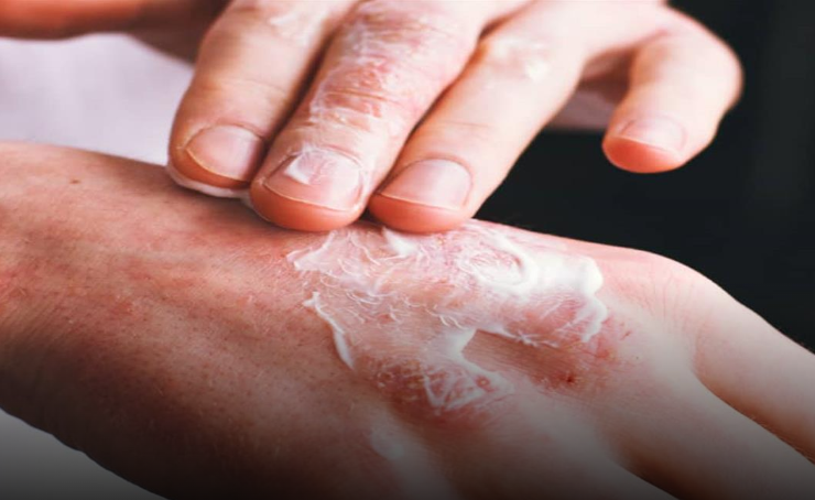 طرق الوقاية من البلاجرا- إليك أعراضها