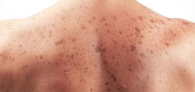 5 طرق بسيطة لتفادي سرطان الجلد