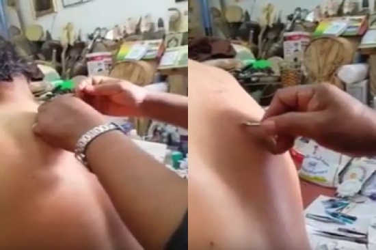 بالفيديو ..  معالج شعبي يستخرج خيوط من ظهر مريض