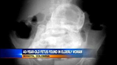 كولومبية تحمل بجنين في بطنها 40 عاماً