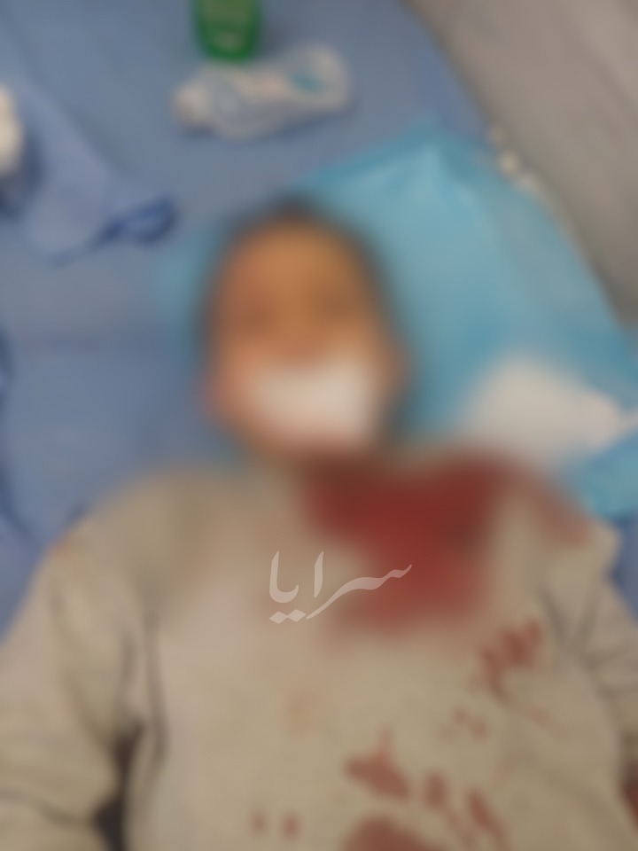 إصابة طفل بجروح خطيرة إثر عضة كلب في الزرقاء