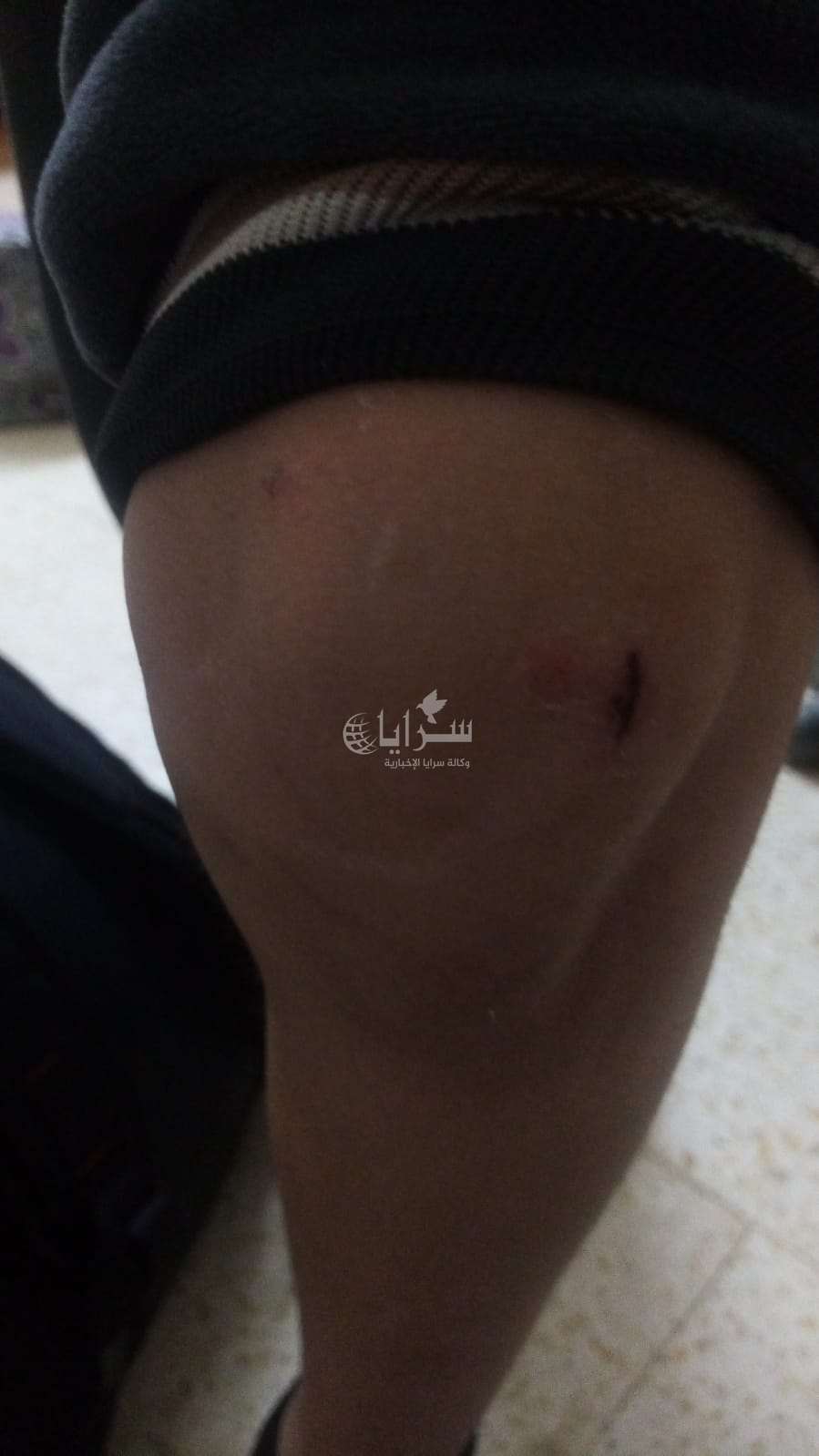 بالصور ..  كلاب ضالة تهاجم طفلاً في الخالدية بالمفرق ..  ومطالبات بحلول عاجلة  