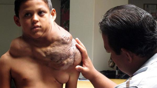 ​إزالة ورم كبير من عنق طفل مكسيكي "صورة"