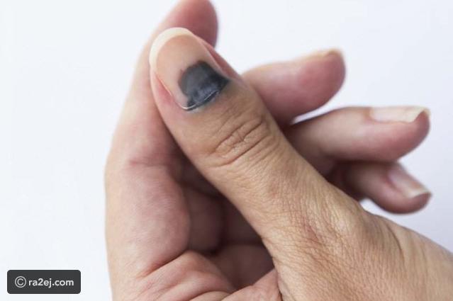 علاج احتباس الدم تحت الأظافر وأهم الإسعافات المنزلية 