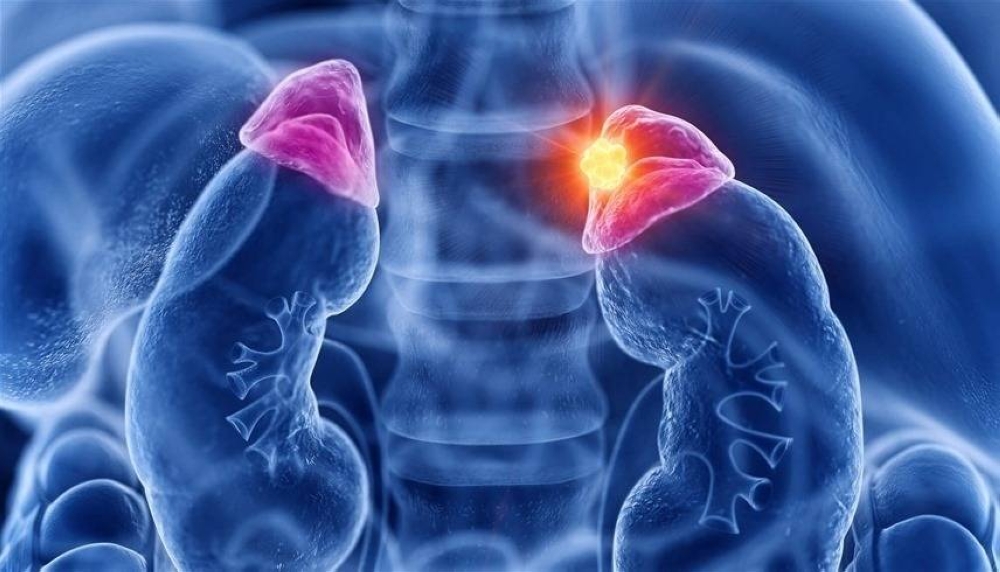 ما هي متلازمة كون التي تصيب الغدد؟