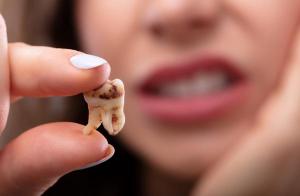 اكتشاف بكتيريا تسبب تسوس الأسنان في ضروس بشرية عمرها 4000 عام