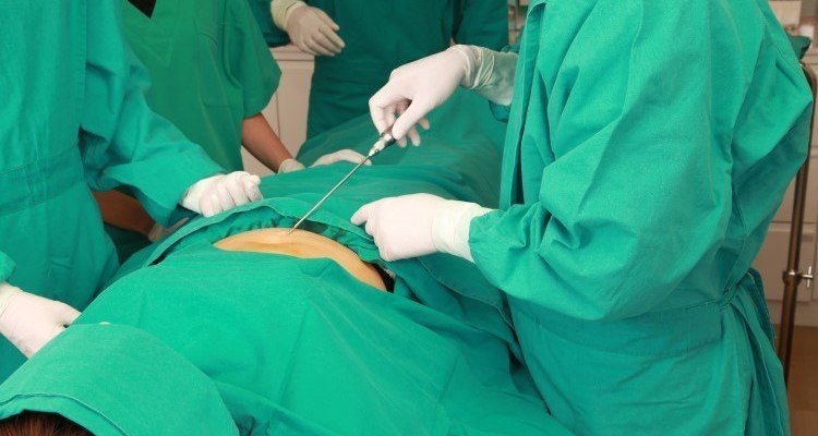 توقيف طبيبين اثر وفاة سيدة ثلاثينية بعملية شفط دهون ..  تفاصيل