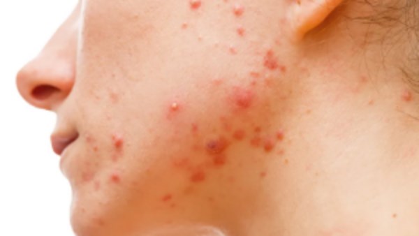 علامات تحذيرية ..  البثور ليست حب الشباب