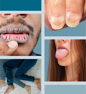 علامات غريبة لنقص الحديد- 7 أعراض احترس منها