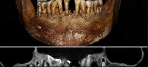 بعد مئات الأعوام من وفاتها ..  جثة تكشف سر الحفاظ على أسنانها