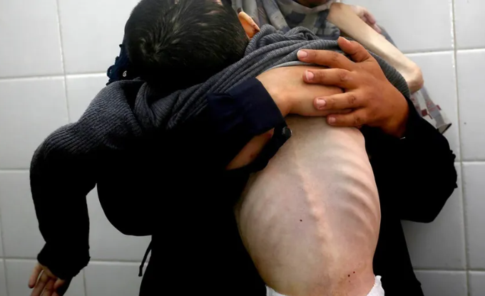 6 وفيات جديدة نتيجة التجويع في غزة