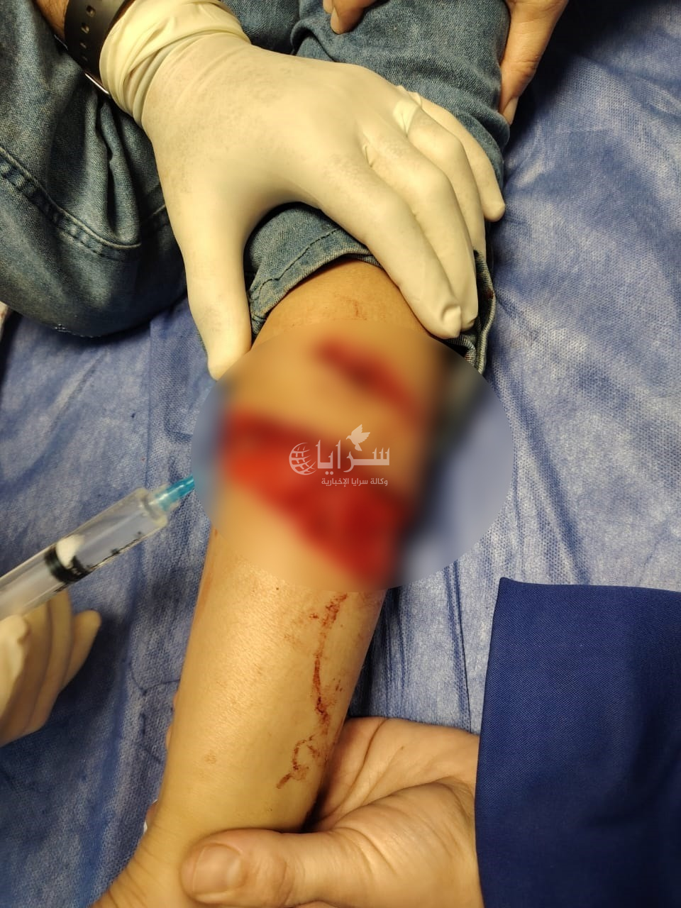 اصيبت بجروح خطيرة  ..  كلب ضال يهاجم وينهش طفلة في الرمثا   ..  صور 