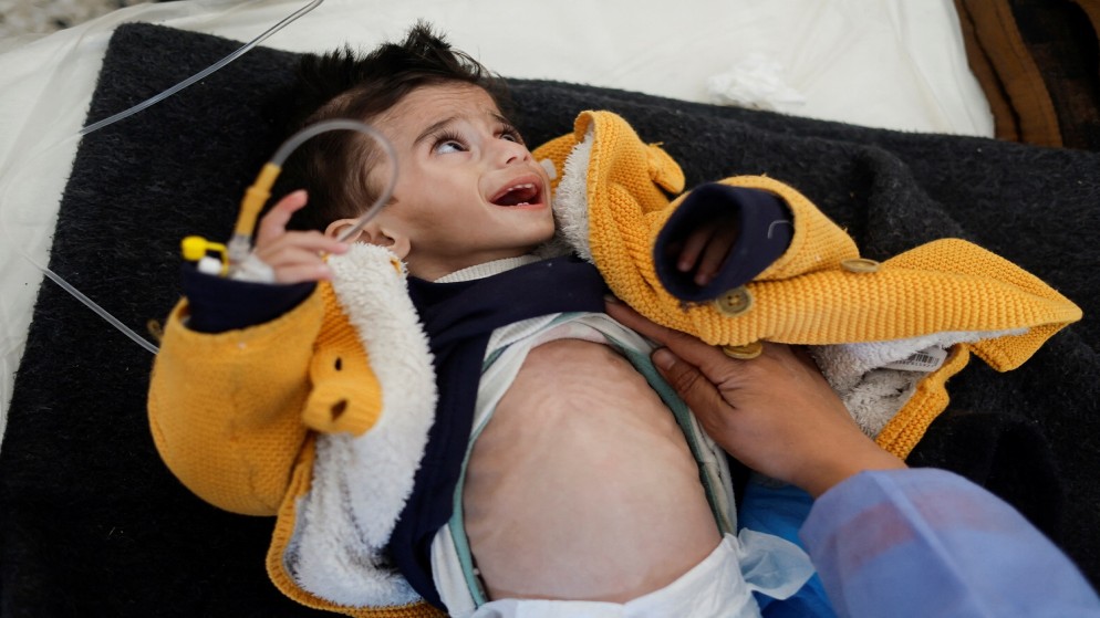 ارتفاع عدد الأطفال الشهداء بسبب سوء التغذية والجفاف في غزة إلى 18