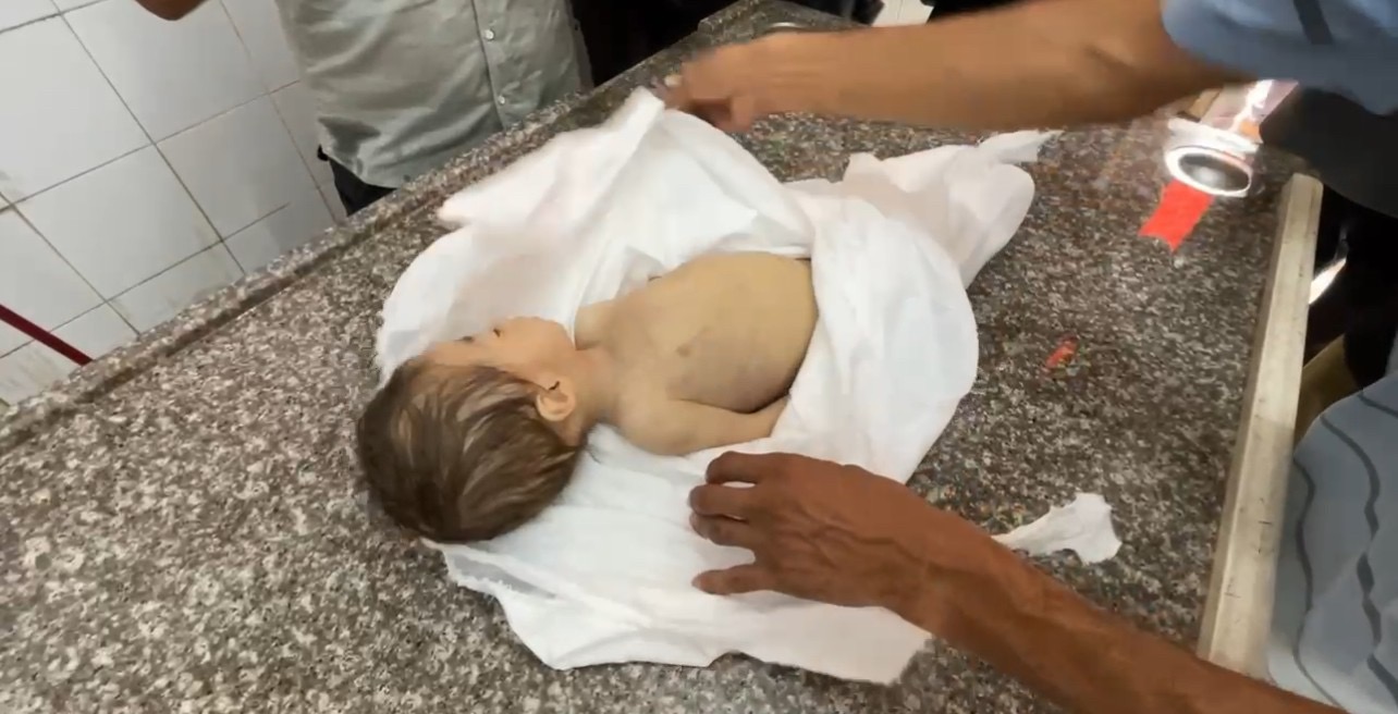 وفاة طفلة بسبب الجوع في قطاع غزة