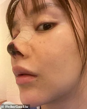 ممثلة تخضع لعملية تجميل في أنفها فأصبح أسود ومتعفن!