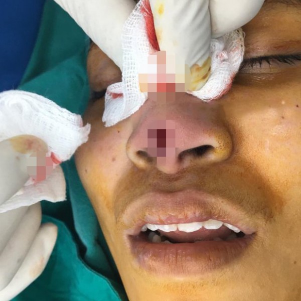 عملية تجميل في أنف امرأة تنتهي بكارثة