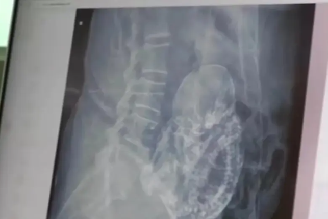 جنين عمره 40 عاما ..  آلام في بطن ثمانينية تكشف المفاجأة!