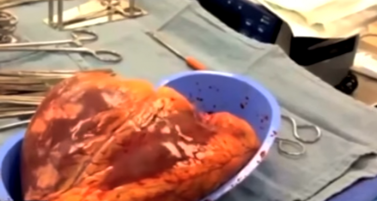 فيديو : قلب حقيقي بقي ينبض خارج الجسم لـ25 دقيقة لهاذ السبب!!