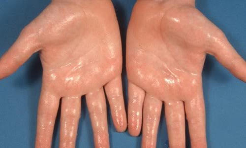 علاجات منزلية للتخلص من تعرّق اليدين