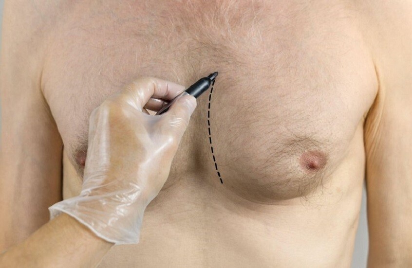 تثدي الرجل يزيد خطر الإصابة بالسرطان 3-5 مرات