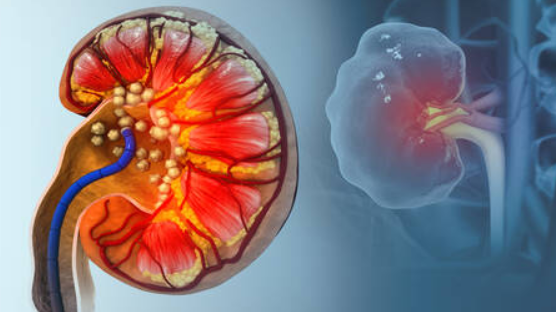 دراسة تفجر مفاجأة عن السبب الحقيقي لتكون حصوات الكلى