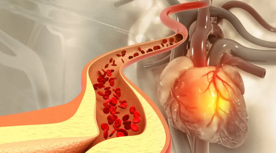 علامة صامتة حول العين قد تكشف خطر نوبة قلبية