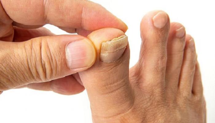عادة يومية تترك أظافر قدميك صفراء ومتشققة ..  طبيبة تكشف السبب والحل