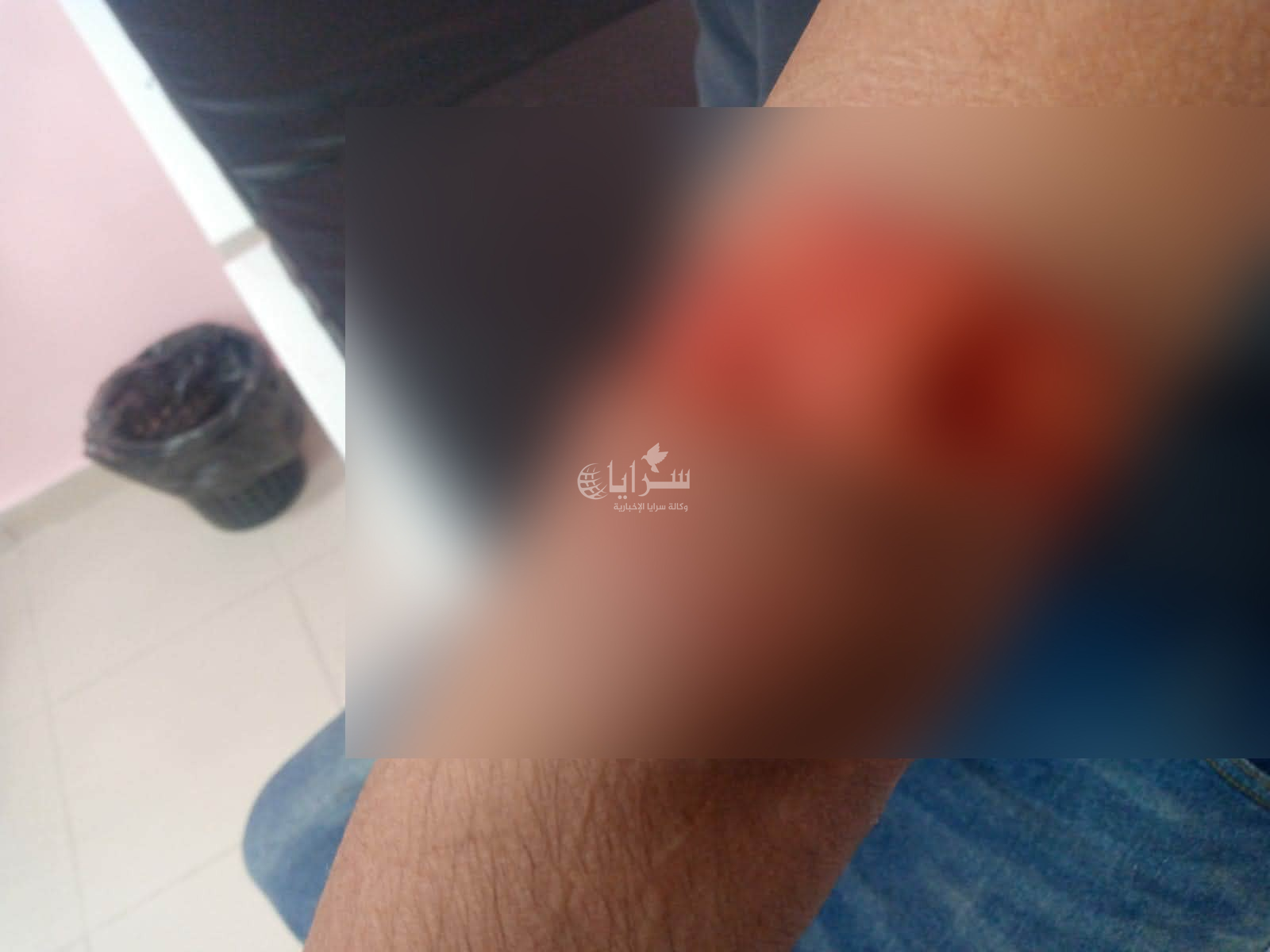 صور صادمة  ..  (7) حالات عقر من الكلاب الضالة في منطقة المشارع بالاغوار الشمالية 