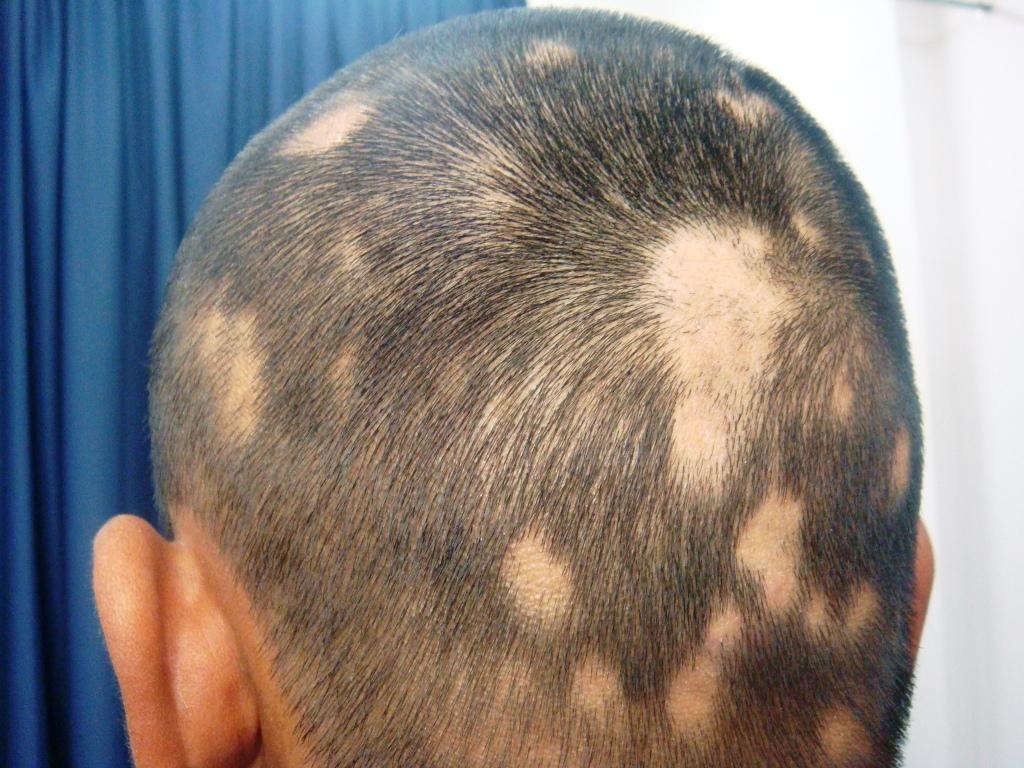 تفسير رؤية داء الثعلبة في المنام