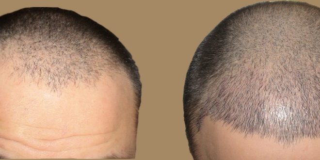 خطوات عملية زراعة الشعر والتقنيات المستخدمة