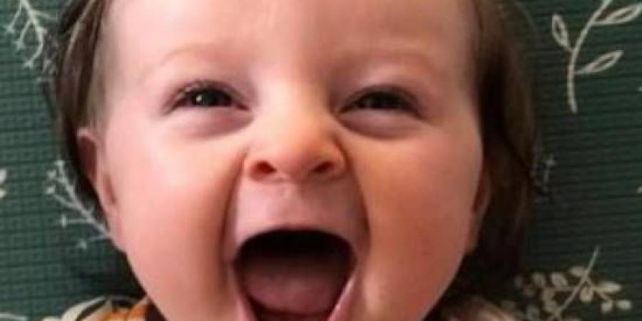 بسبب حالة وراثية نادرة  ..  رضيعة استرالية لا تتوقف عن الضحك