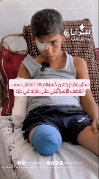طفل فلسطيني فقد عينه وذراعه وساقه بعد قصف الاحتلال لمنزل عائلته في مدينة غزة - فيديو 