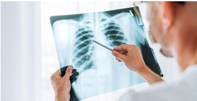 الالتهاب الرئوي ..  كيف تحول الإنفلونزا رئتيك إلى ساحة معركة حياة أو موت؟