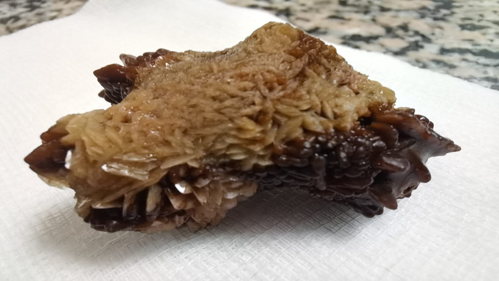 لأول مرة في الأردن ..  عملية نوعية لاستخراج حصوة من الكلى باستخدام المنظار في مأدبا