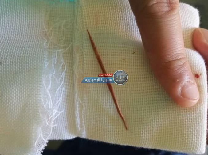 استخراج "نكاشة أسنان" من داخل كبد فتاة سورية