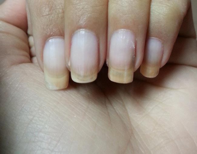 أسباب اصفرار الأظافر