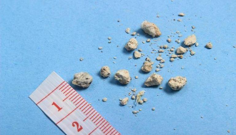 علاج جديد لتفتيت حصوات الكلى دون ألم