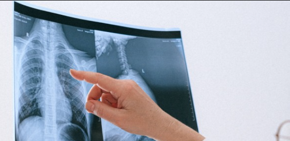 الناسور القصبي هو حالة غير شائعة