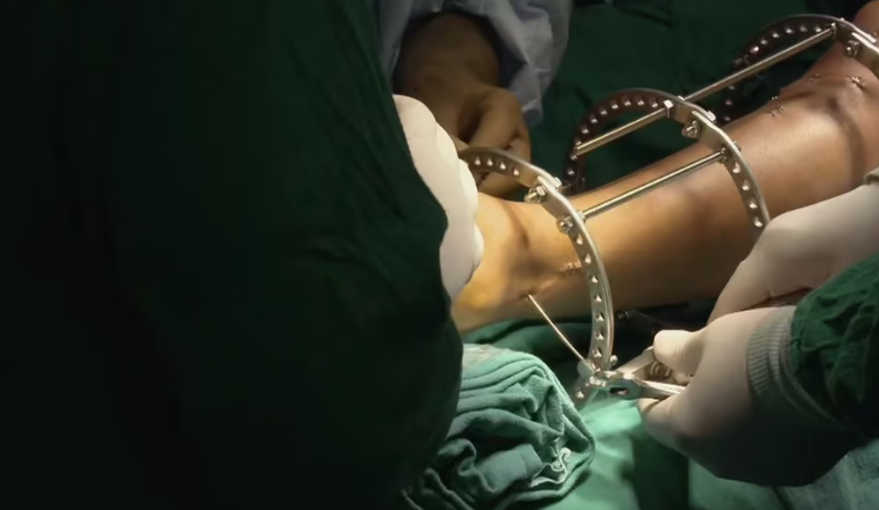 وفاة مواطن سعودي بعد عملية لإطالة القامة في تركيا