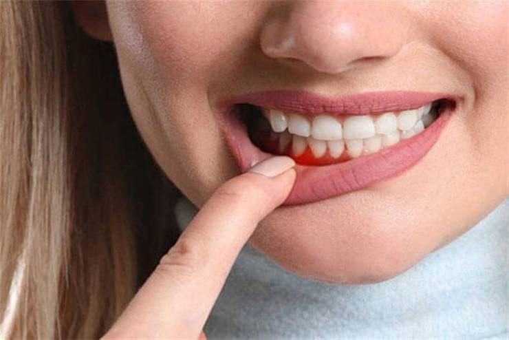 ما أسباب التهاب اللثة وكيفية الوقاية منه؟