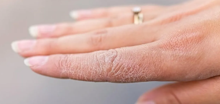 بشرتك تكشف الخطر ..  علامات مبكرة للسكري تظهر على الجلد
