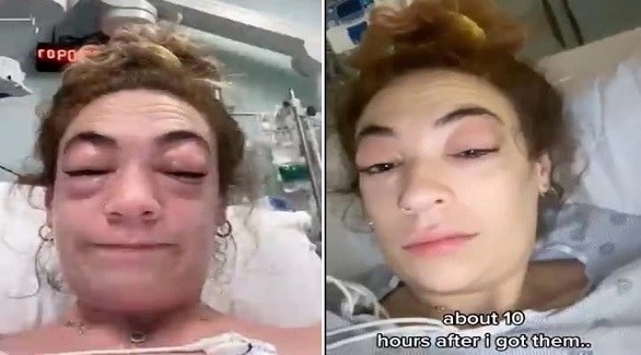 تصاب بحساسية شديدة بسبب وصلات الرموش